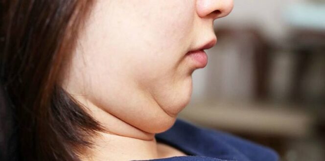 
					Menghilangkan Double Chin Dengan Senam Wajah