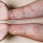 Dermatitis Kontak Menular? Cek Faktanya